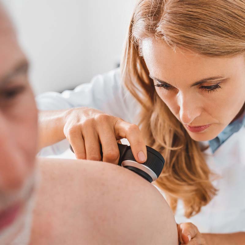 Controllo dei nei con dermatoscopio presso Polimedpiù a Mentana