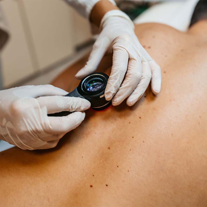 Visita dermatologica con controllo dei nei